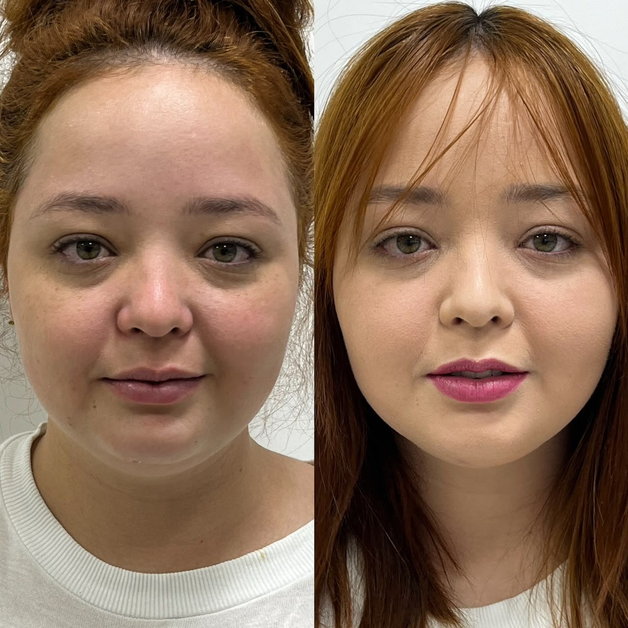 Antes e depois de harmonização facial feminina — paciente da Dra. Aline Castelo em Brasília