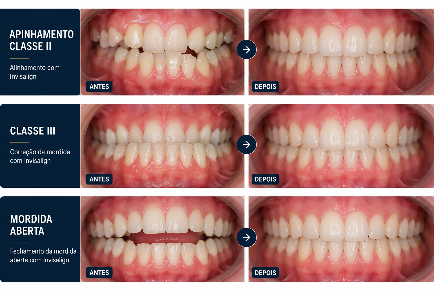Casos clínicos Invisalign — Apinhamento Classe II, Classe III e Mordida Aberta — antes e depois