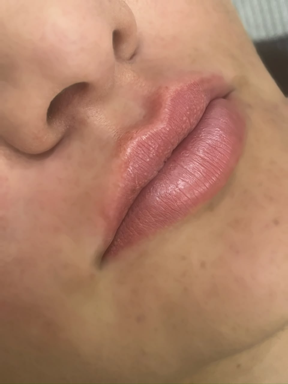 Lábios antes do preenchimento labial — Dra. Aline Castelo, Brasília