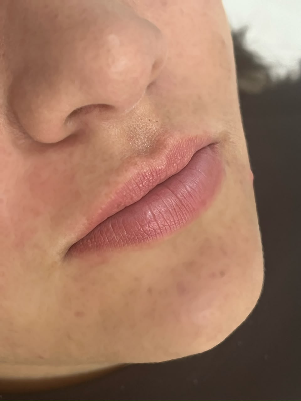 Lábios após preenchimento labial natural — Dra. Aline Castelo, harmonização facial Brasília