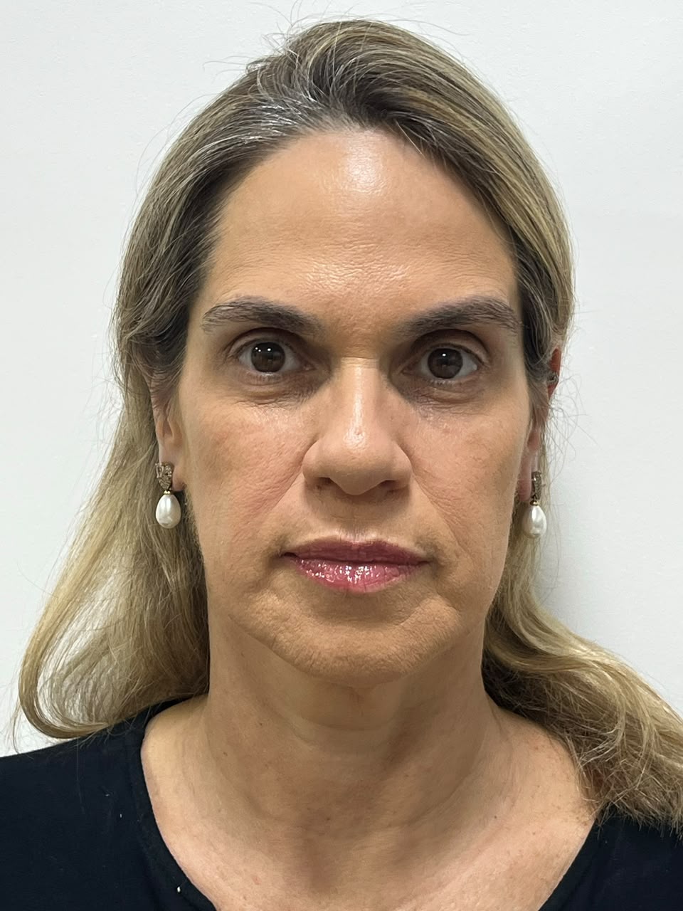 Paciente antes do protocolo de rejuvenescimento facial — Dra. Aline Castelo